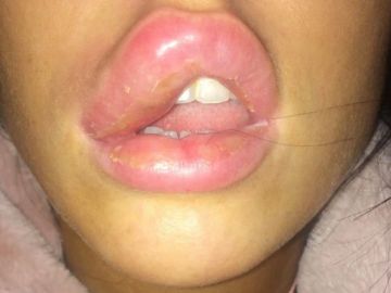 Imagen de Jessica Myott con el labio hinchado debido a la infección. Imagen de Jessica Myott con el labio hinchado debido a la infección.