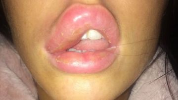 Imagen de Jessica Myott con el labio hinchado debido a la infección.