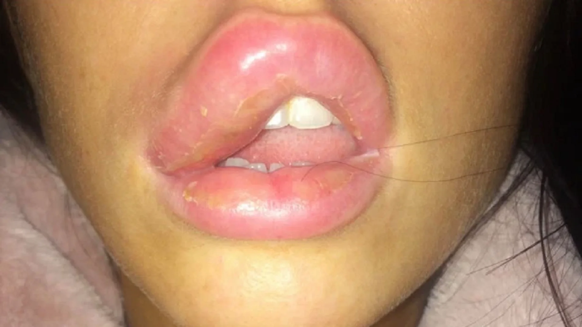 Imagen de Jessica Myott con el labio hinchado debido a la infección.