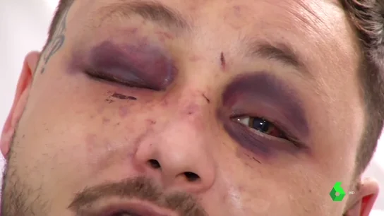 Le desfiguran la cara a un joven en una brutal paliza por ayudar a una mujer maltratada por su pareja Le desfiguran la cara a un joven en una brutal paliza por ayudar a una mujer maltratada por su pareja