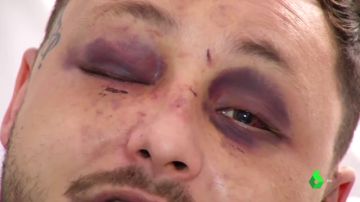 Le desfiguran la cara a un joven en una brutal paliza por ayudar a una mujer maltratada por su pareja