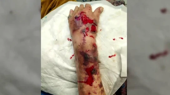 El brazo del anciano tras sufrir la agresión El brazo del anciano tras sufrir la agresión