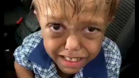 Quaden tiene 9 años y sufre Bullying constantemente en el colegio Bullying