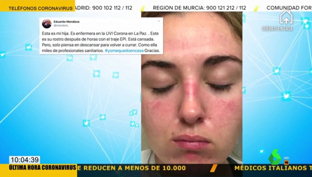 La Imagen De Una Enfermera Con El Rostro Marcado Que Visibiliza El