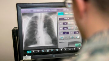 Radiografias de torax para detectar la COVID 19