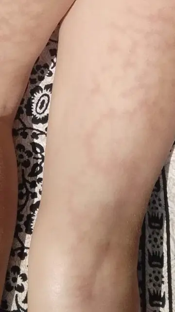 Lesiones livedo reticulares asociadas a la COVID Lesiones livedo reticulares