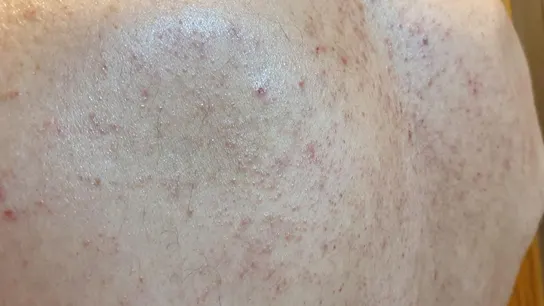 Lesiones cutáneas vesiculosas asociadas al COVID-19 Lesiones cutáneas vesiculosas asociadas al COVID-19