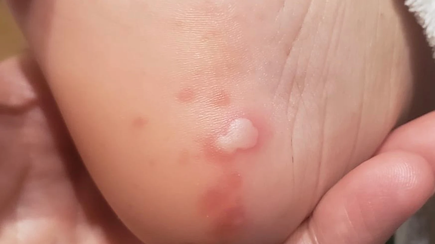 Lesiones cutáneas acrales relacionadas con el coronavirus Lesiones cutáneas acrales relacionadas con el coronavirus