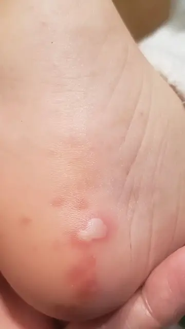 Lesiones cutáneas acrales relacionadas con el coronavirus Lesiones cutáneas acrales relacionadas con el coronavirus