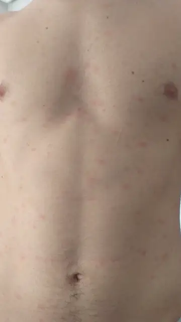 Lesiones maculo-papulares asociadas al coronavirus Lesiones maculo-papulares asociadas al coronavirus