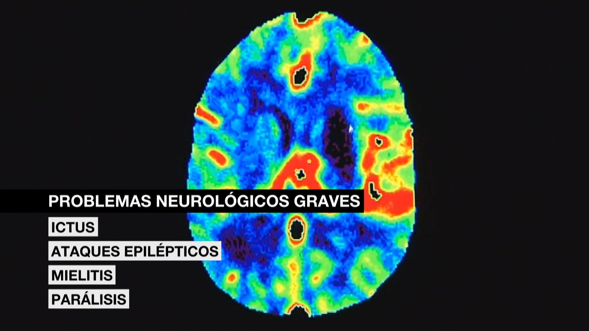 Secuelas graves del coronavirus