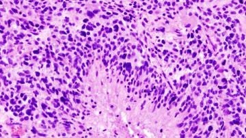 glioblastoma