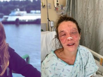 Imagen de Marta antes y después del accidente con sosa cáustica Imagen de Marta antes y después del accidente con sosa cáustica