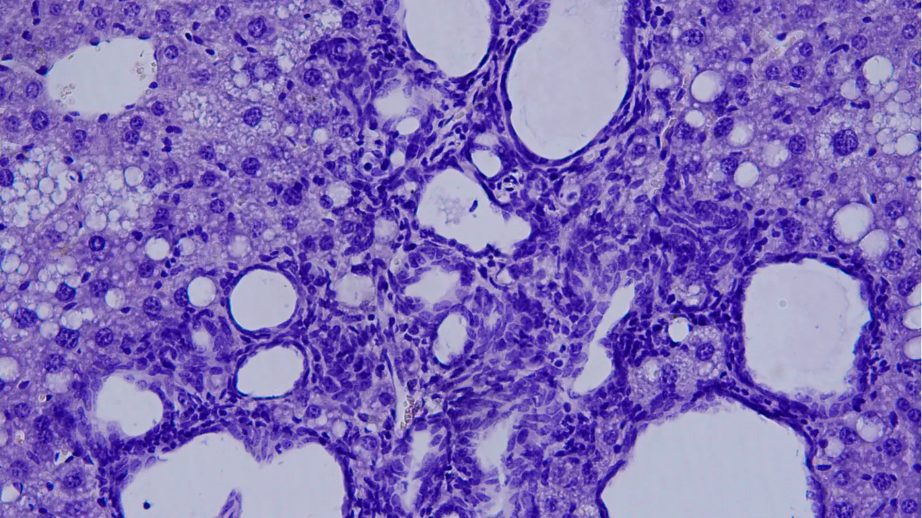 Colangiocarcinoma