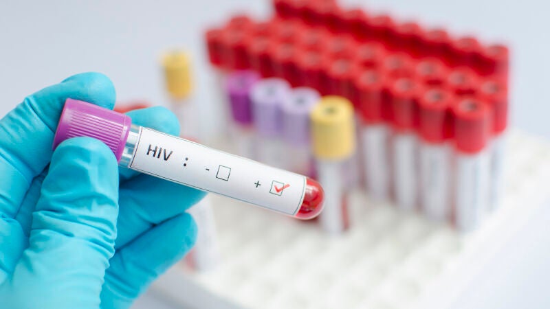 Posible primer caso de desaparición del VIH en un paciente tratado sólo con medicación
