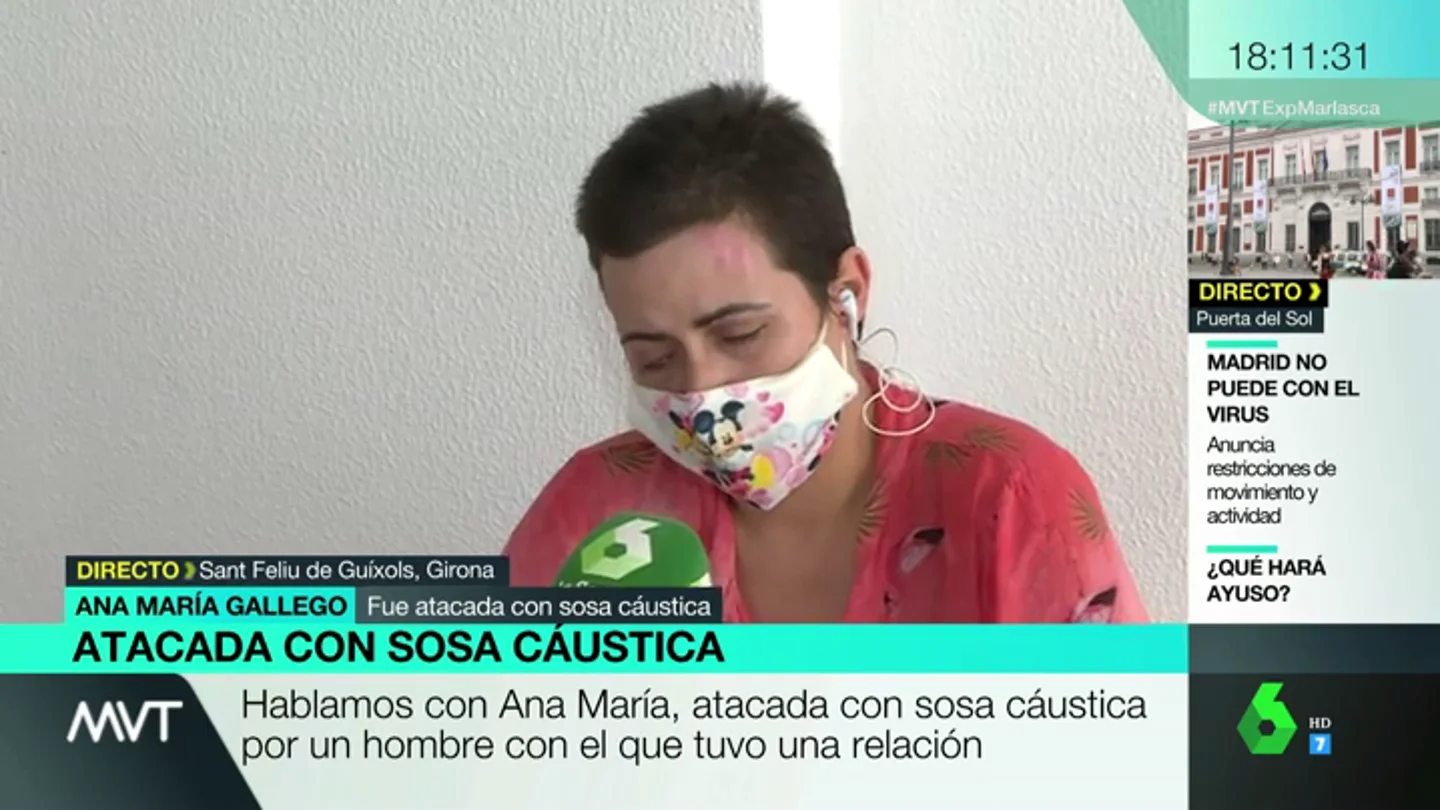 Ana María, atacada con sosa cáustica por una expareja Ana María, atacada con sosa cáustica por una expareja
