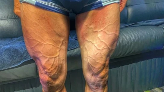 Las piernas de Rojas tras la séptima etapa Consecuencias del esfuerzo de los ciclistas