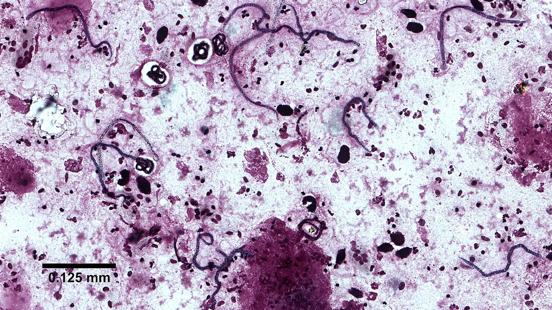 Oncocercosis humana