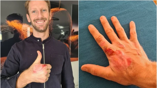 Así han quedado las manos de Grosjean tras su accidente Así han quedado las manos de Grosjean tras su accidente