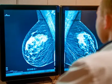 Cancer de mama Cancer de mama