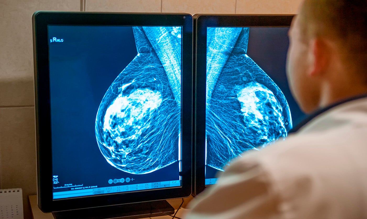 Algunas mujeres con cancer de mama podran evitar la quimioterapia