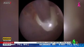 Impactantes imágenes: extraen un diente del tímpano de un niño de tres años