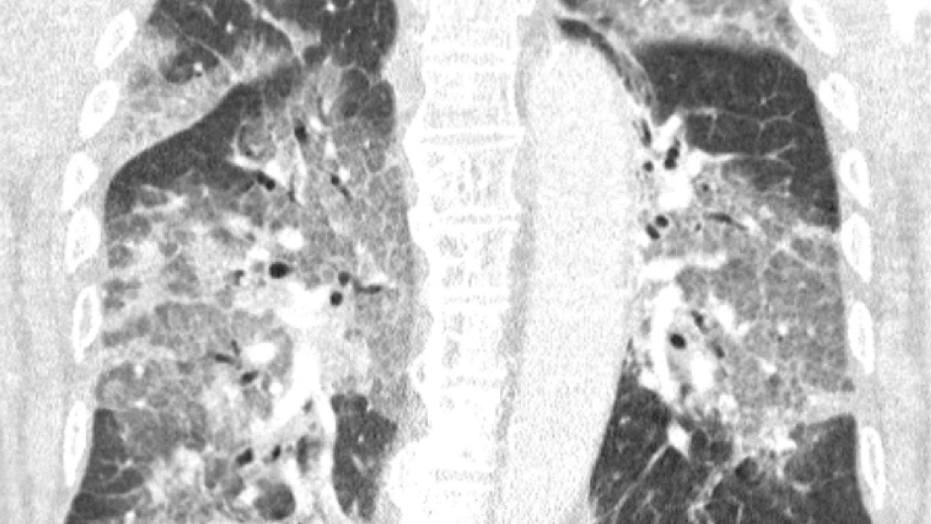 Radiografía de los pulmones de un paciente con coronavirus ingresado en la UCI