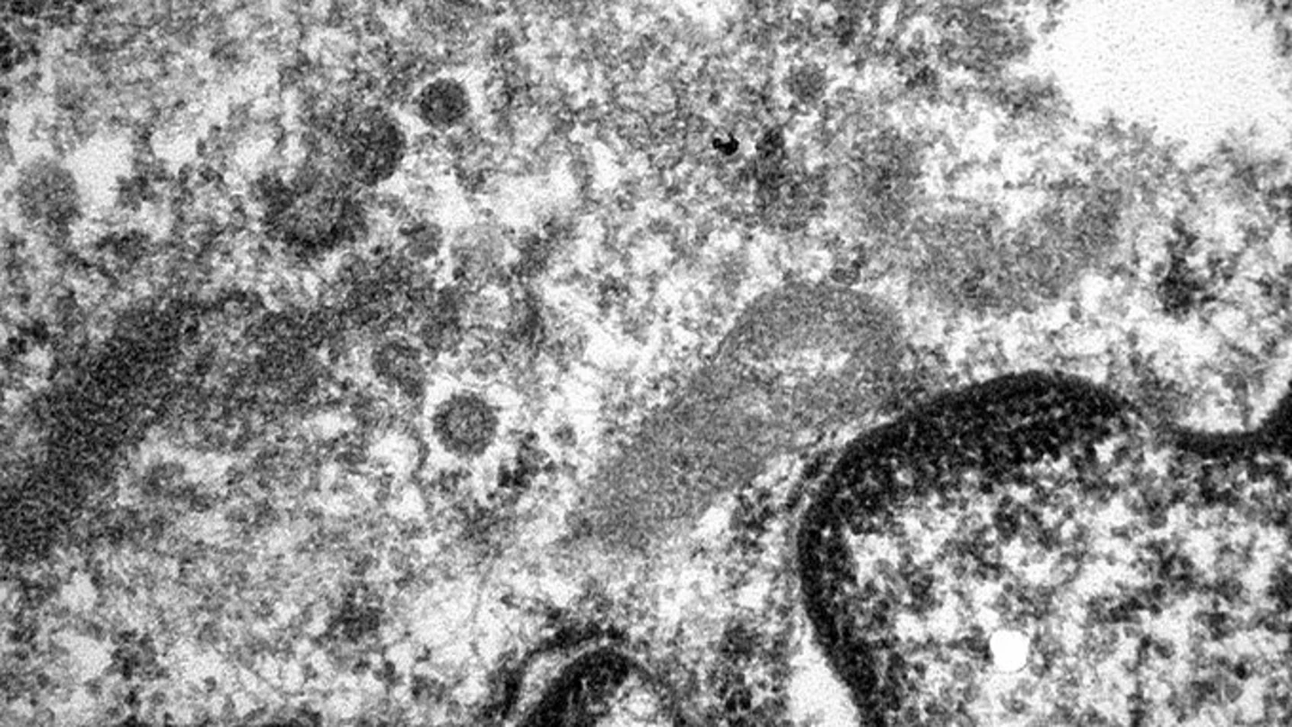 El coronavirus en los vasos sanguíneos de un paciente infectado El coronavirus en los vasos sanguíneos de un paciente infectado