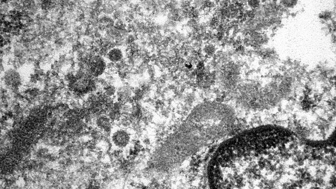 El coronavirus en los vasos sanguíneos de un paciente infectado