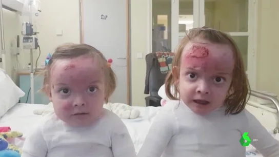 Carla y Noa, dos gemelas de seis años con piel de mariposa Carla y Noa, dos gemelas de seis años con piel de mariposa