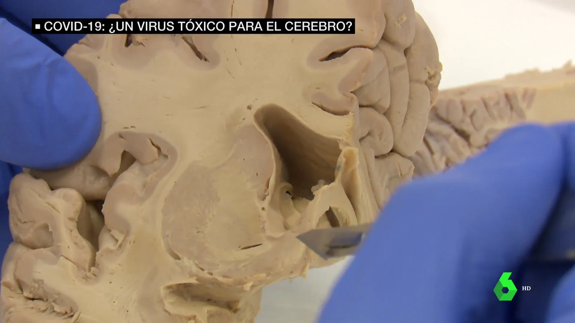 daños cerebro COVID