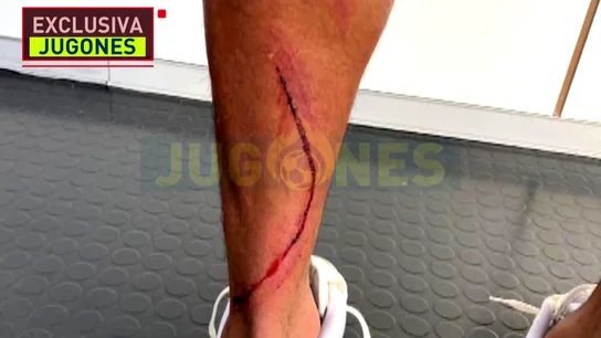 Exclusiva 'Jugones': así quedó la pierna de Marvin tras la entrada de Machís Exclusiva 'Jugones': así quedó la pierna de Marvin tras la entrada de Machís
