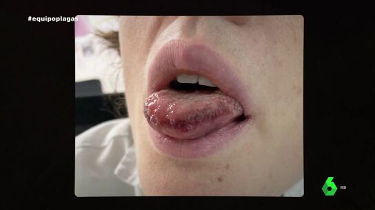 Urticaria, lesiones al&eacute;rgicas... los problemas m&eacute;dicos que puede dar la procesionaria