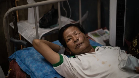 Imagen de archivo de un hombre con Hongo Negro en la India Imagen de archivo de un hombre con Hongo Negro