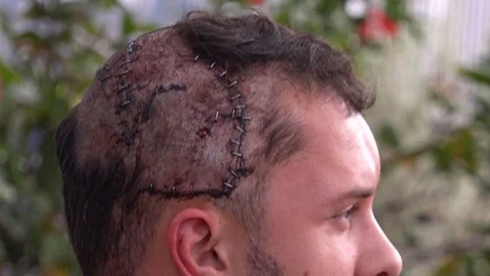 Heridas de la cabeza de Jeffrey Heim tras el mordisco de un cocodrilo Heridas de la cabeza de Jeffrey Heim tras el mordisco de un cocodrilo