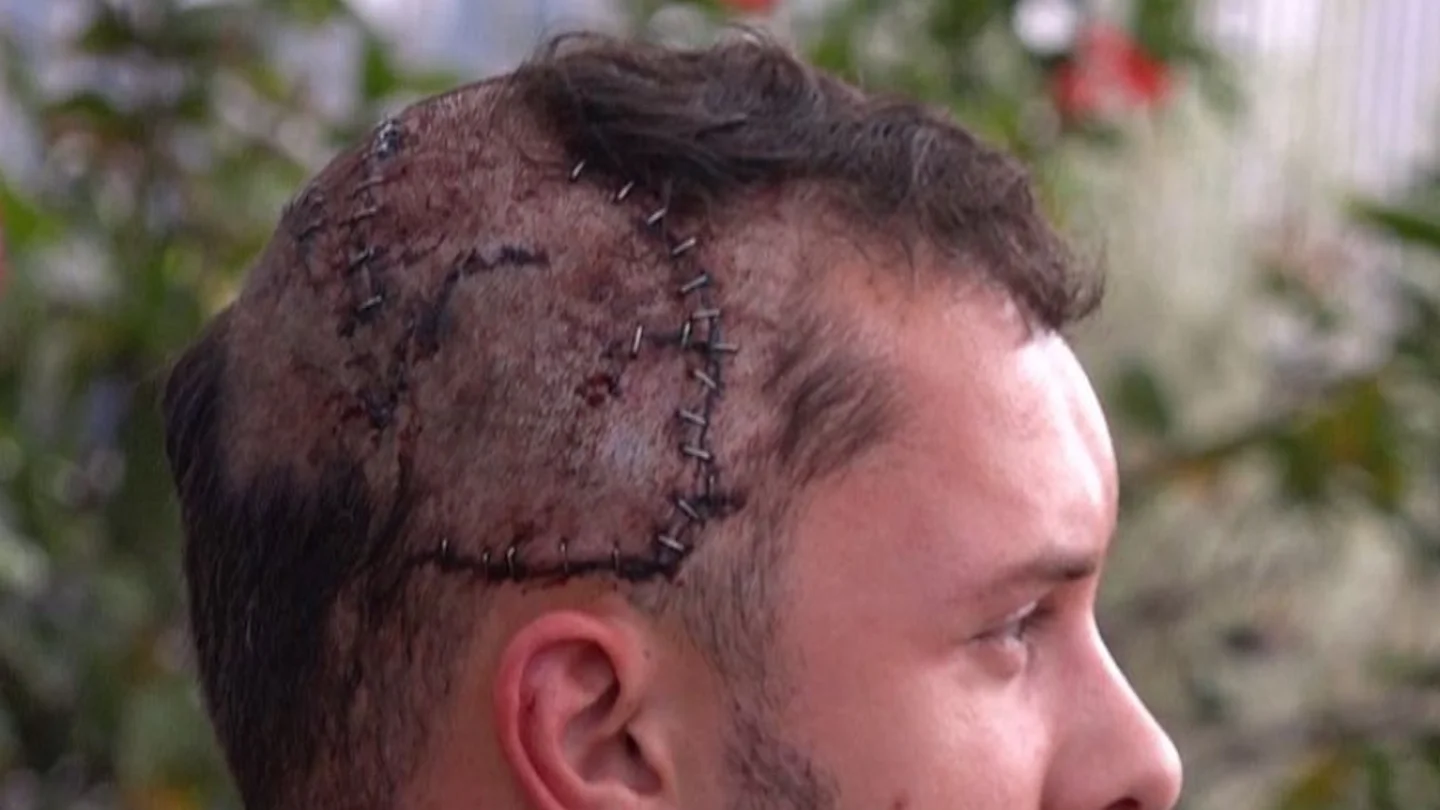 Heridas de la cabeza de Jeffrey Heim tras el mordisco de un cocodrilo Heridas de la cabeza de Jeffrey Heim tras el mordisco de un cocodrilo