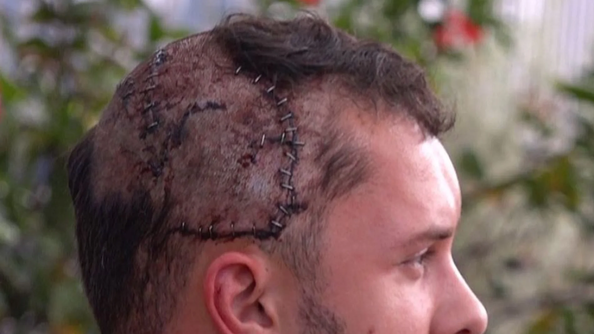 Heridas de la cabeza de Jeffrey Heim tras el mordisco de un cocodrilo