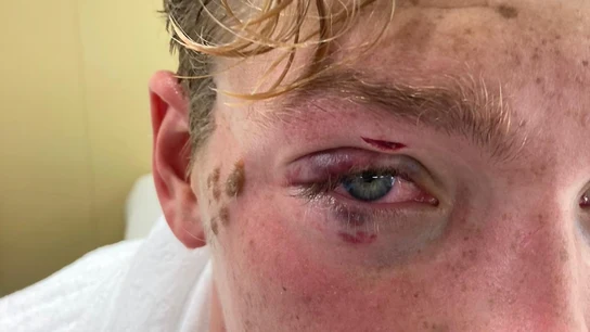 Recibió un codazo y no pudo seguir: "No veía, pensé que mi ojo se había caído al agua" Recibió un codazo y no pudo seguir: "No veía, pensé que mi ojo se había caído al agua"