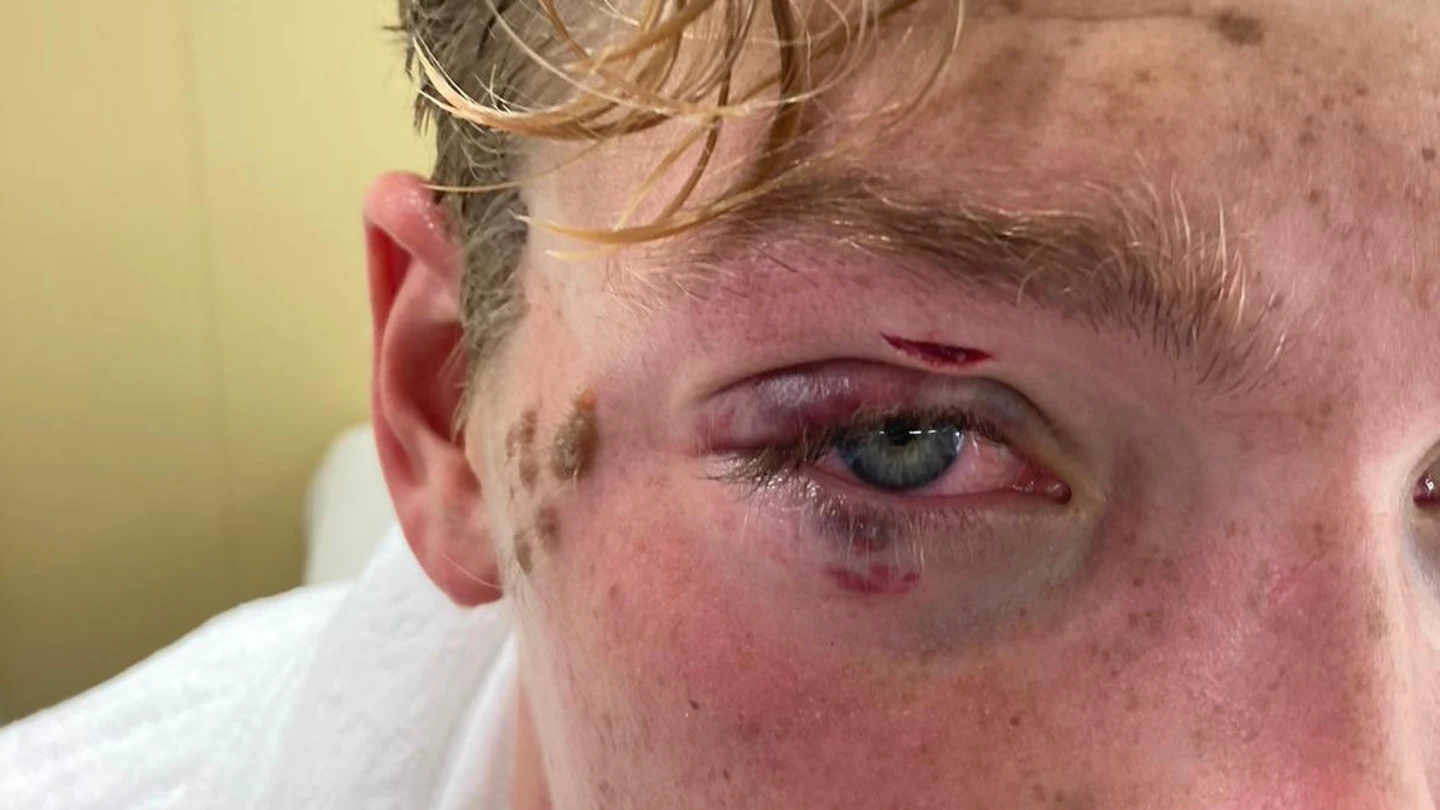 Recibió un codazo y no pudo seguir: "No veía, pensé que mi ojo se había caído al agua" Recibió un codazo y no pudo seguir: "No veía, pensé que mi ojo se había caído al agua"