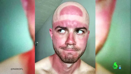 Estas son las quemaduras de sol más surrealistas de las redes Estas son las quemaduras de sol más surrealistas de las redes