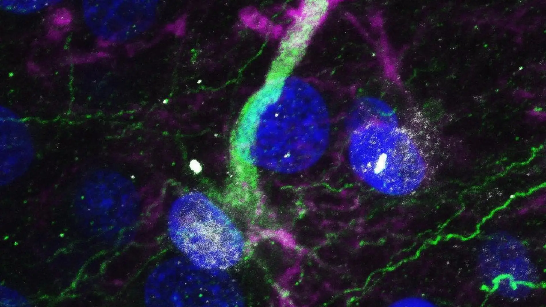 Demuestran que las enfermedades neurodegenerativas atacan a las celulas madre del cerebro y les impiden generar neuronas sanas