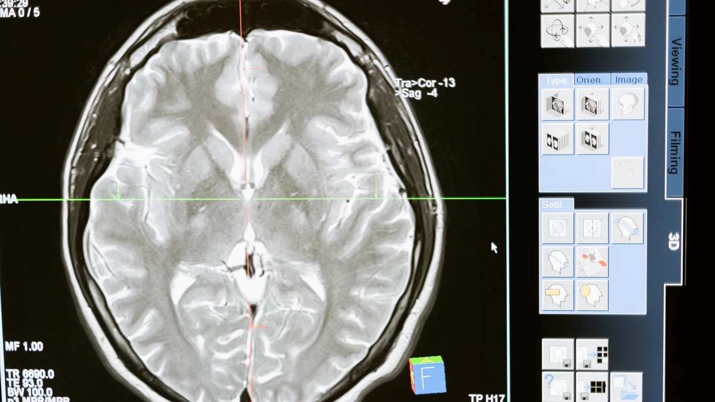Escáner cerebral Escáner cerebral