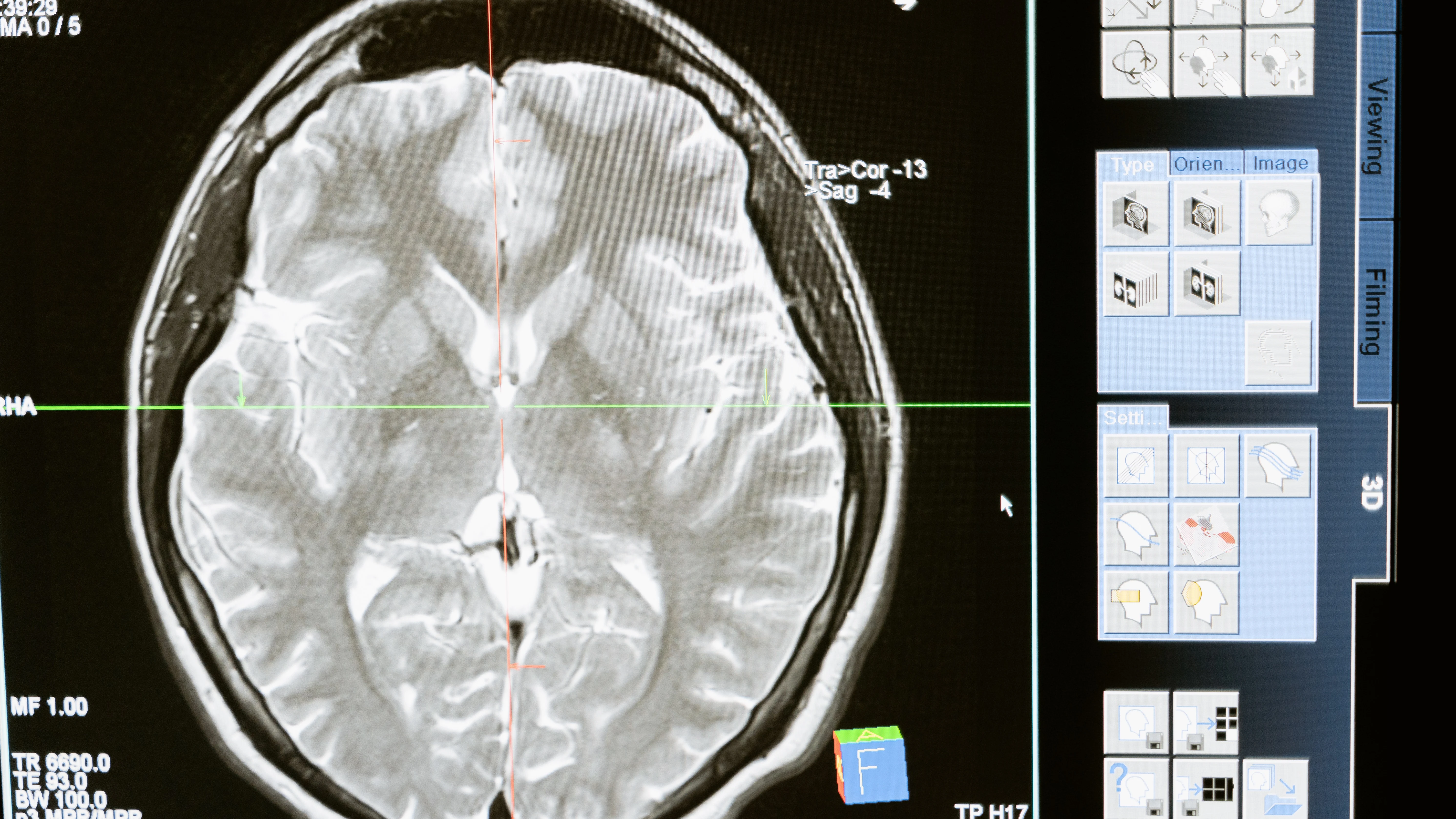 Escáner cerebral