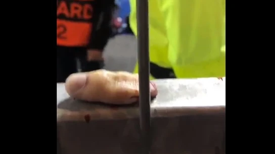 Aficionados pierde un dedo durante un partido Aficionados pierde un dedo durante un partido