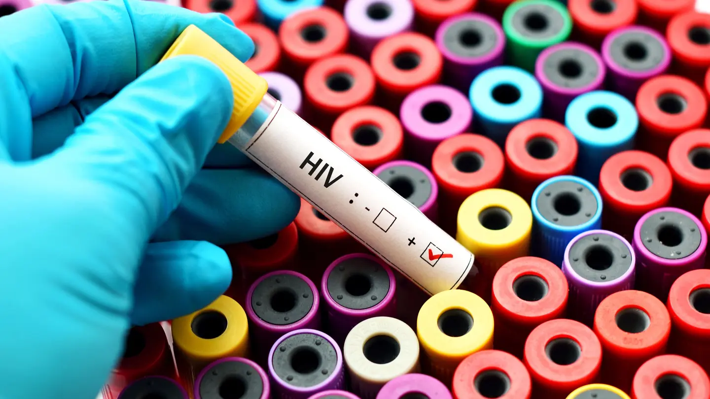 Análisis de sangre con resultado VIH positivo Análisis de sangre con resultado VIH positivo