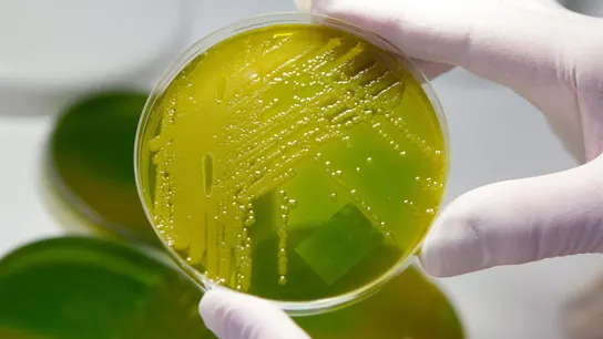 El virus de la enfermedad del beso podría ser causa principal de la esclerosis múltiple El virus de la enfermedad del beso podría ser causa principal de la esclerosis múltiple