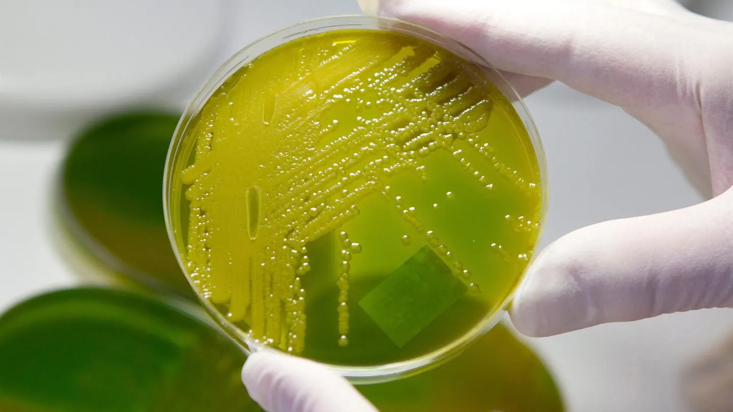 El virus de la enfermedad del beso podría ser causa principal de la esclerosis múltiple El virus de la enfermedad del beso podría ser causa principal de la esclerosis múltiple