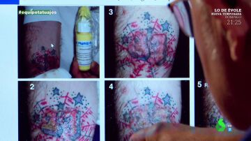 Reacción alérgica a un tatuaje