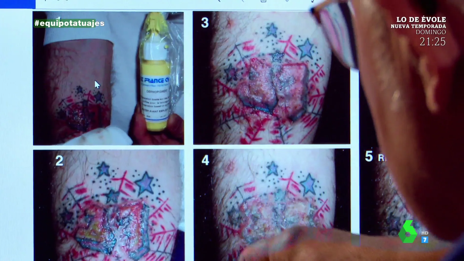 Reacción alérgica a un tatuaje