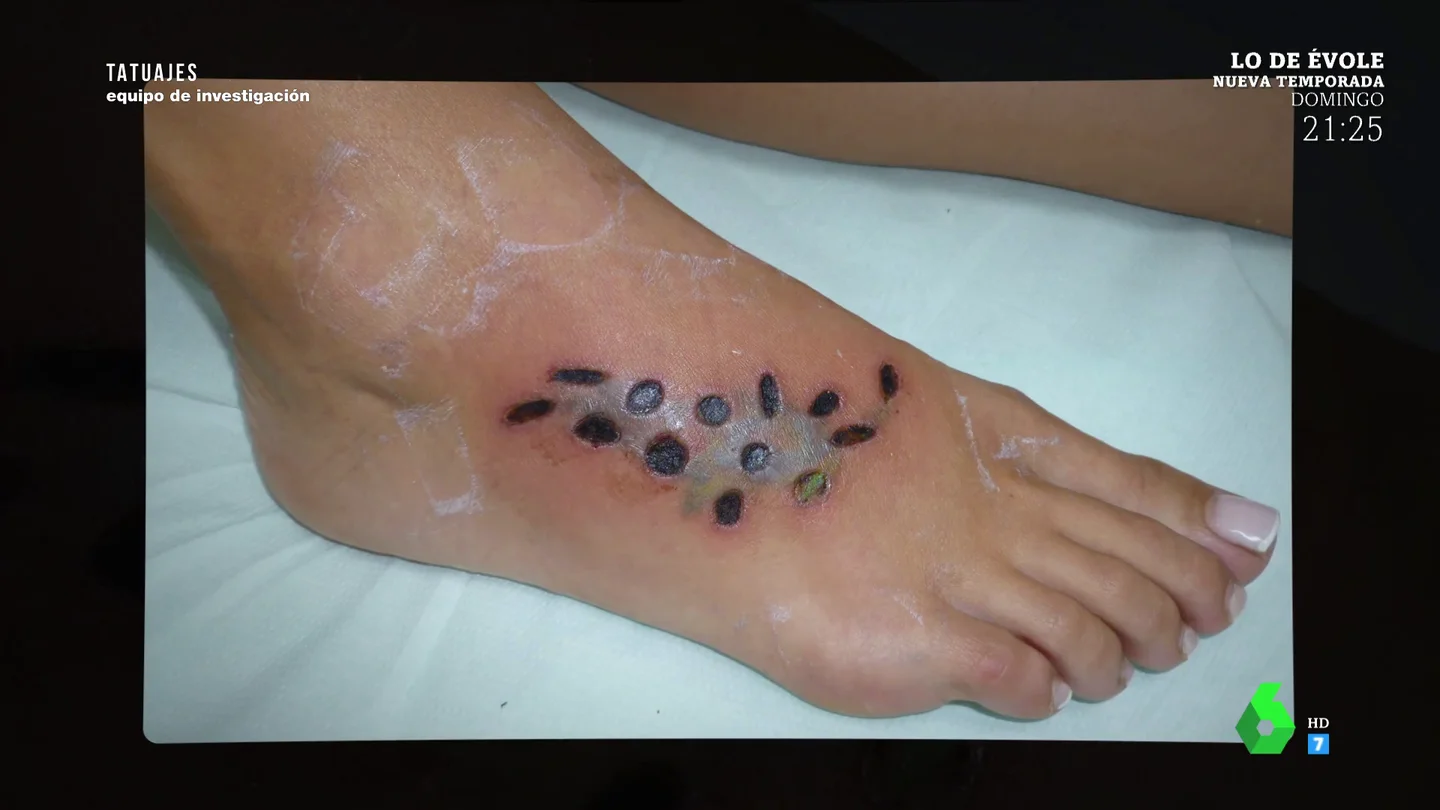Cicatriz al borrar el tatuaje Cicatriz al borrar el tatuaje